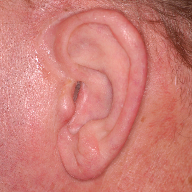 The final result of the auricular (ear) prosthesis, fully attached magnetically to the head, incorporating the small part of the patient’s ear anatomy. Notice the intrinsic coloration making a life-like, barely detectible prosthesis made by master anaplastologist, Susan Habakuk.