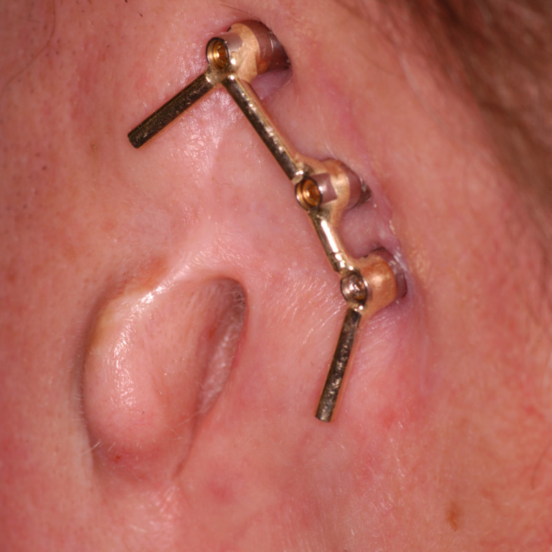 This is a photo of the surgically implanted gold bar that will connect magnetically to corresponding magnets imbedded in the ear prosthesis
