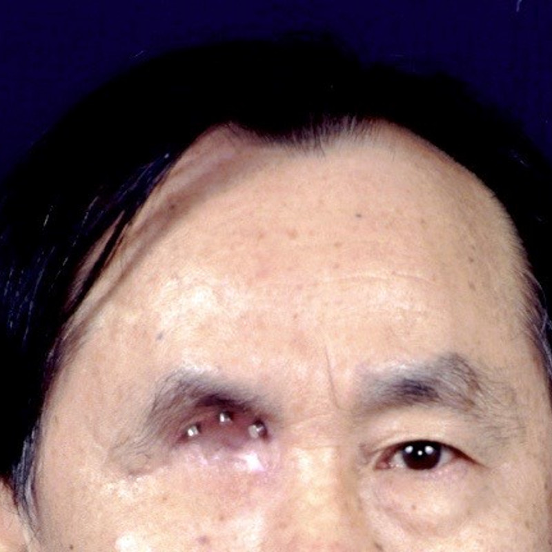 This patient lost his eye to cancer. Implants were placed at the superior area of his orbital bone to be attached to the eventual prosthesis.